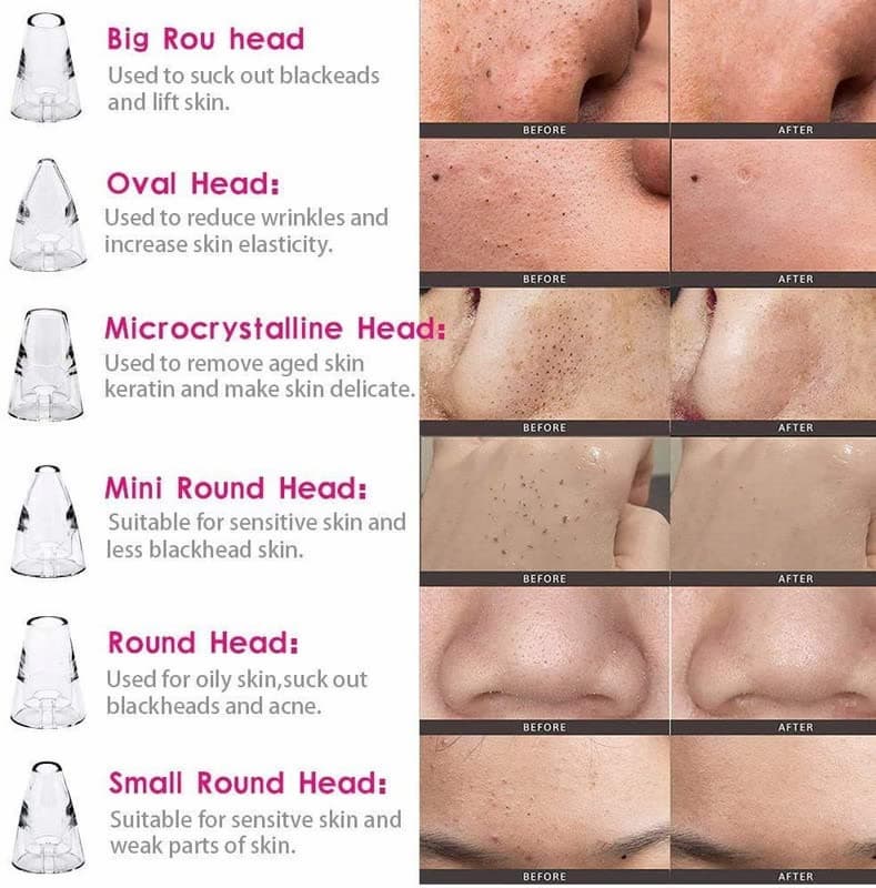 Blackheads remover Rechrgeable